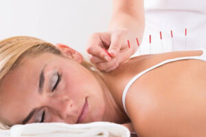 Acupuncture for Stress calming therapy with back needles